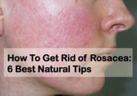 How to get rid of rosacea