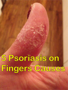 Psoriasis on fingers causes 