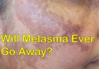 Will Melasma Ever Go Away
