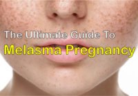 melasma pregnancy