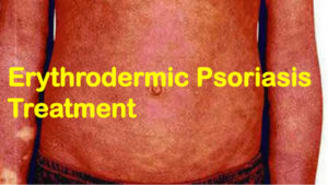 erythrodermic psoriasis treatment