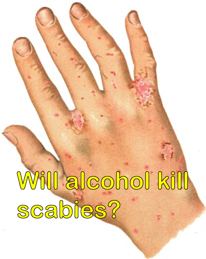 Will alcohol kill scabies