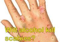 Will alcohol kill scabies