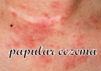 papular-eczema