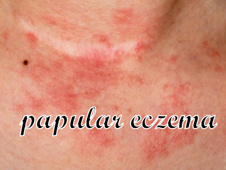 papular eczema