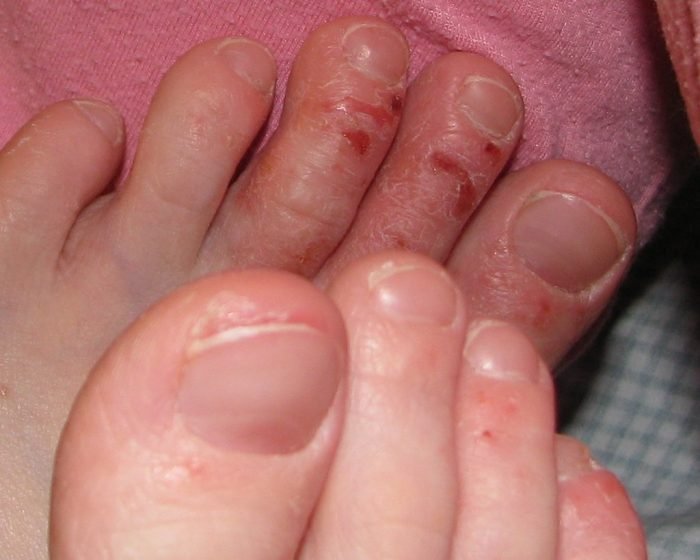 Is Iodine Bad For Eczema