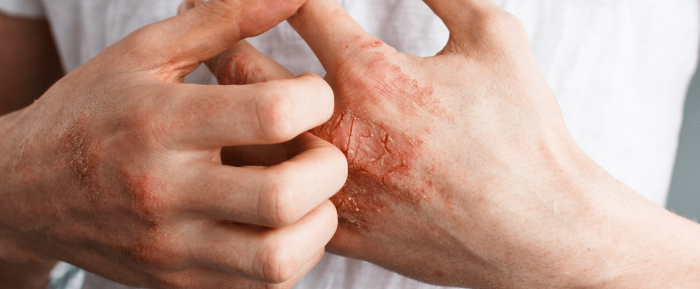 Is Drinking Oat Milk Good For Eczema