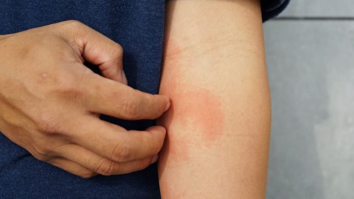 Is Cow's Milk Good For Eczema